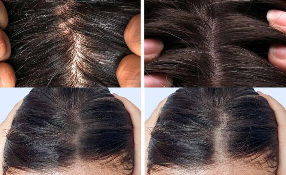 10 Kebiasaan Yang Bikin Rambut Tipis Harus Ditinggalkan Dailysia